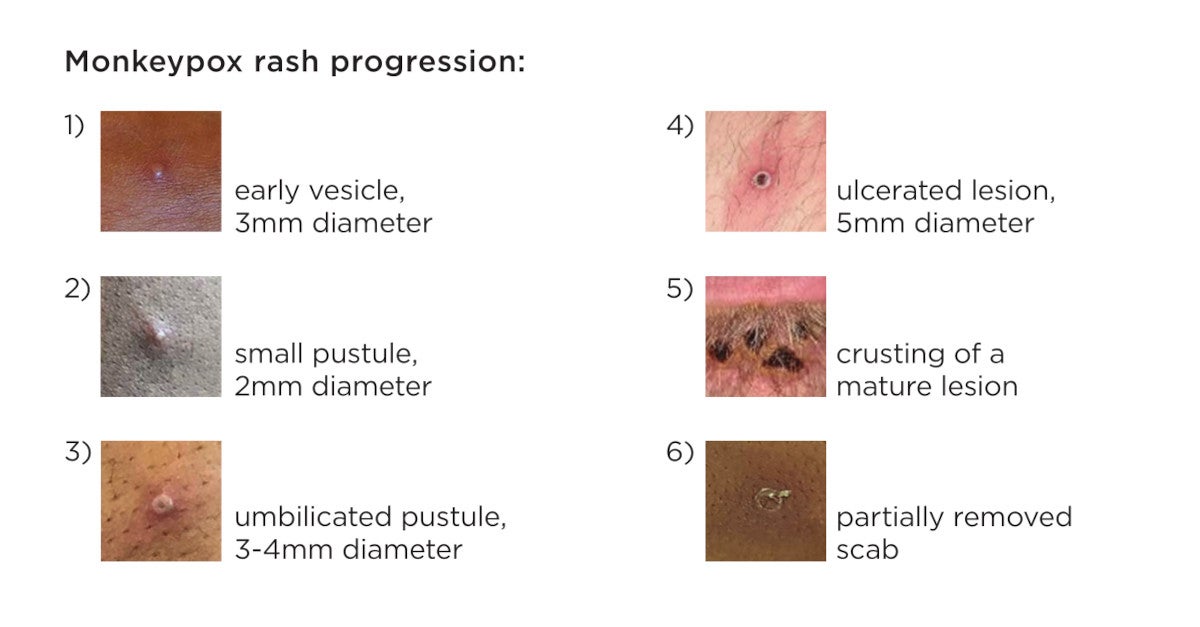 Monkeypox rash progression